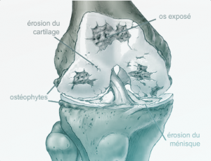 Arthrose du Genou