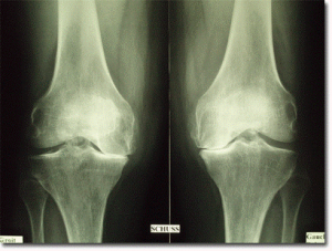 Radiographie du genou avec de l'arthrose.