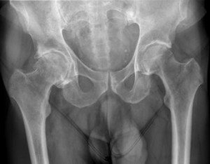 Coxarthrose
