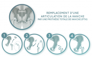 Proth&egrave;se Totale de Hanche - PTH