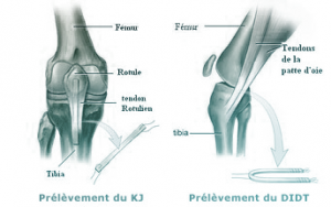 Greffe Ligamentoplastie LCA