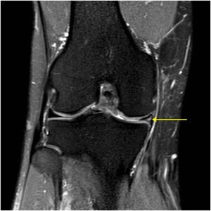 IRM : L&eacute;sion m&eacute;niscale