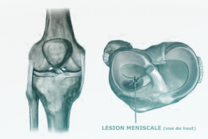 L&eacute;sion m&eacute;niscale