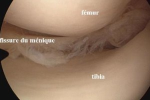 L&eacute;sion M&eacute;niscale