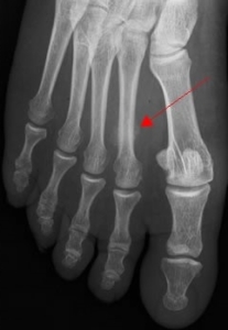 Radiographie d&rsquo;une fracture du IIe m&eacute;tatarsien du pied.