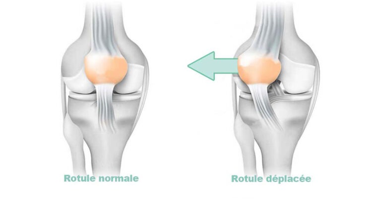 Instabilit&eacute; Rotulienne