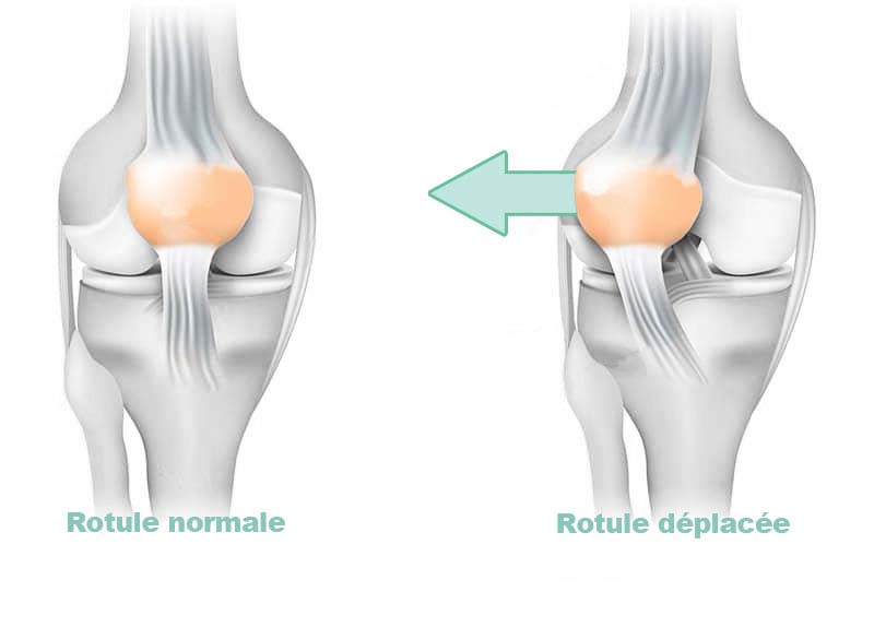 Instabilité Rotulienne