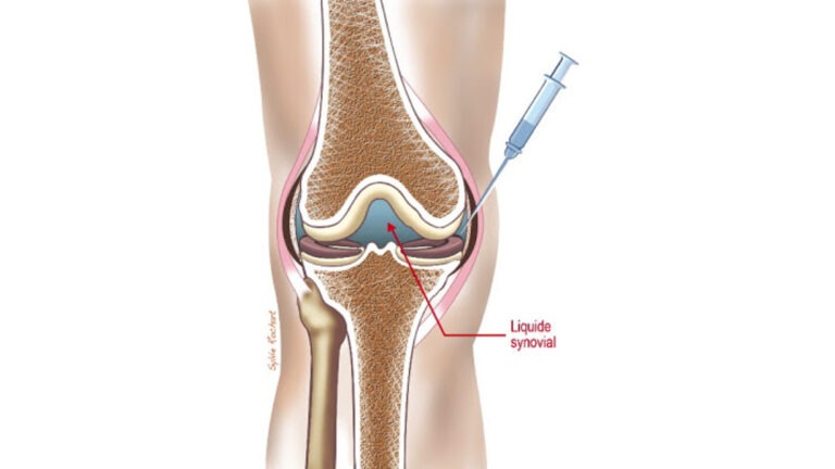 Infiltration du Genou