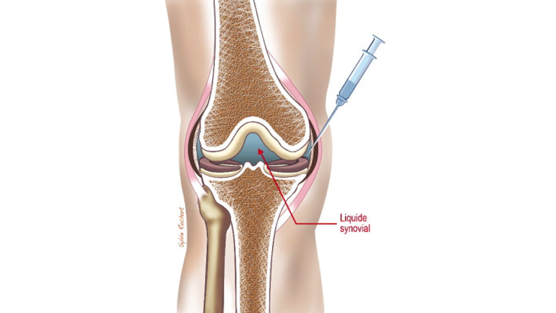Les Infiltrations du Genou