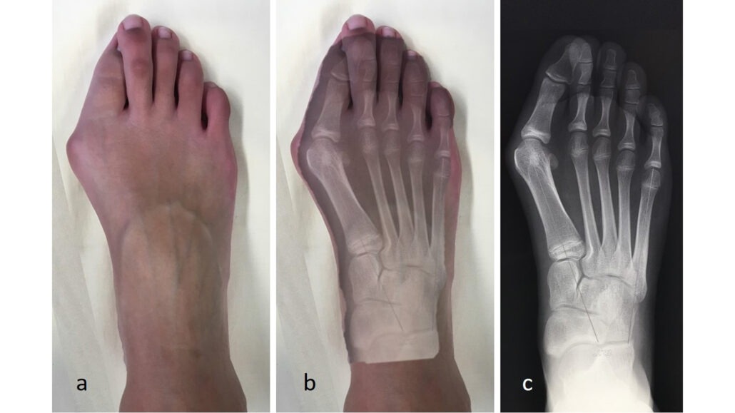 Hallux Valgus