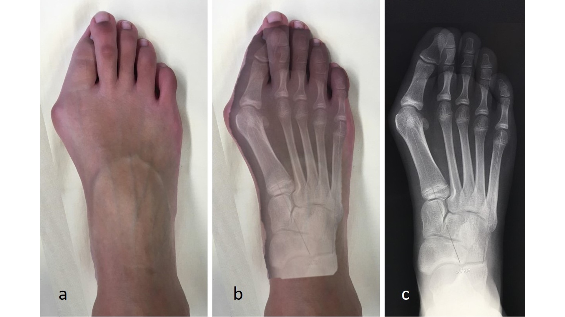 Hallux Valgus