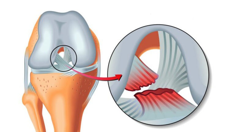 Rupture Des Ligaments Croises